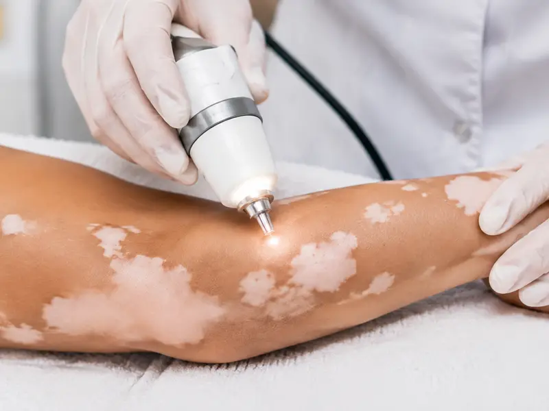 Vitiligo Treatment
