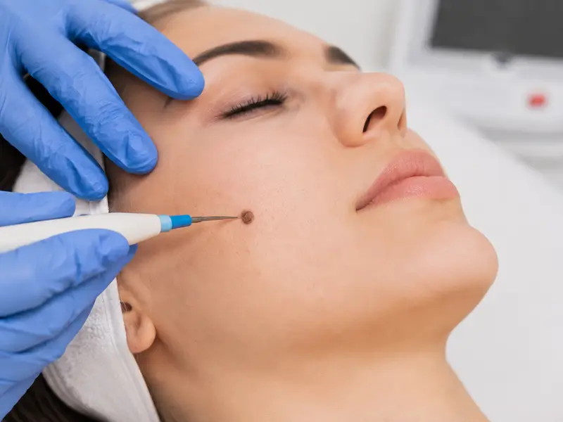Wart Removal Treatment
